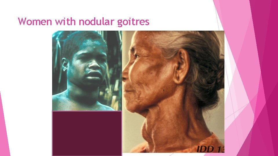 Women with nodular goitres 