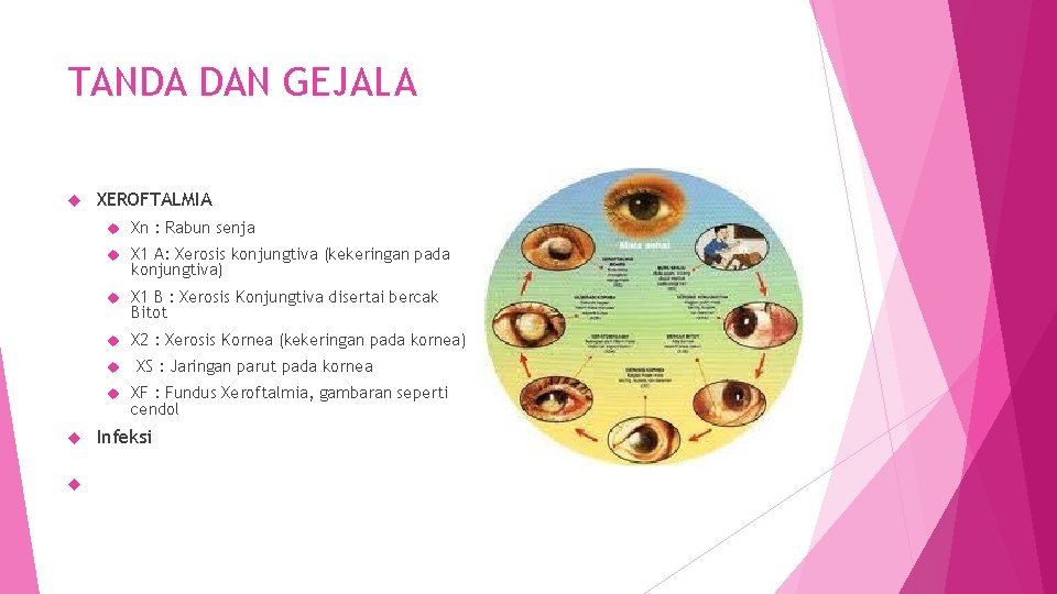 TANDA DAN GEJALA XEROFTALMIA Xn : Rabun senja X 1 A: Xerosis konjungtiva (kekeringan