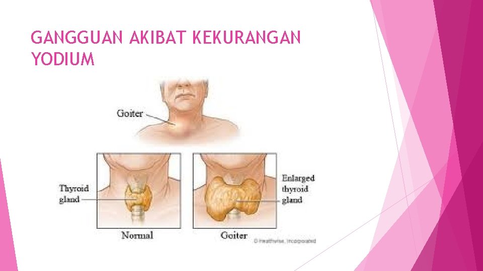 GANGGUAN AKIBAT KEKURANGAN YODIUM 