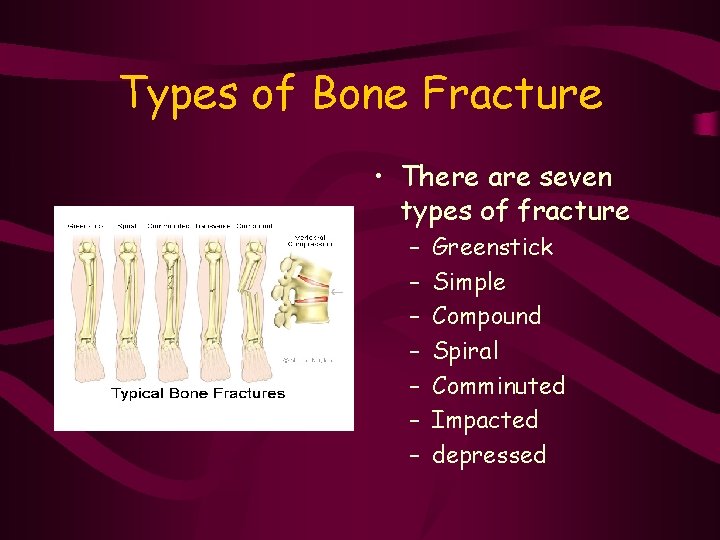 Types of Bone Fracture • There are seven types of fracture – – –