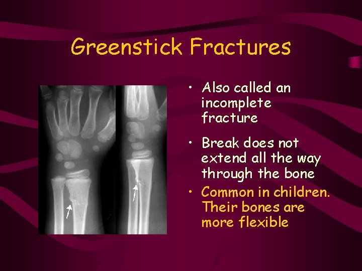 Greenstick Fractures • Also called an incomplete fracture • Break does not extend all