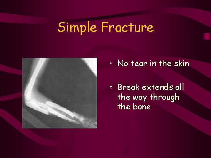 Simple Fracture • No tear in the skin • Break extends all the way