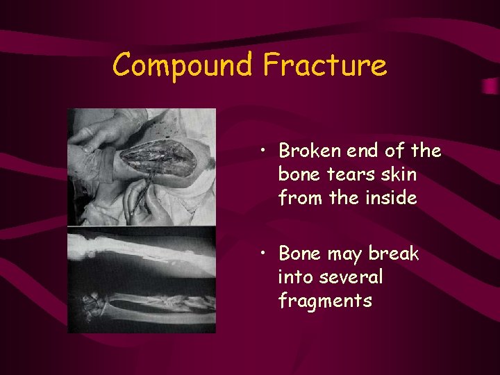 Compound Fracture • Broken end of the bone tears skin from the inside •