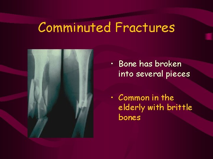 Comminuted Fractures • Bone has broken into several pieces • Common in the elderly