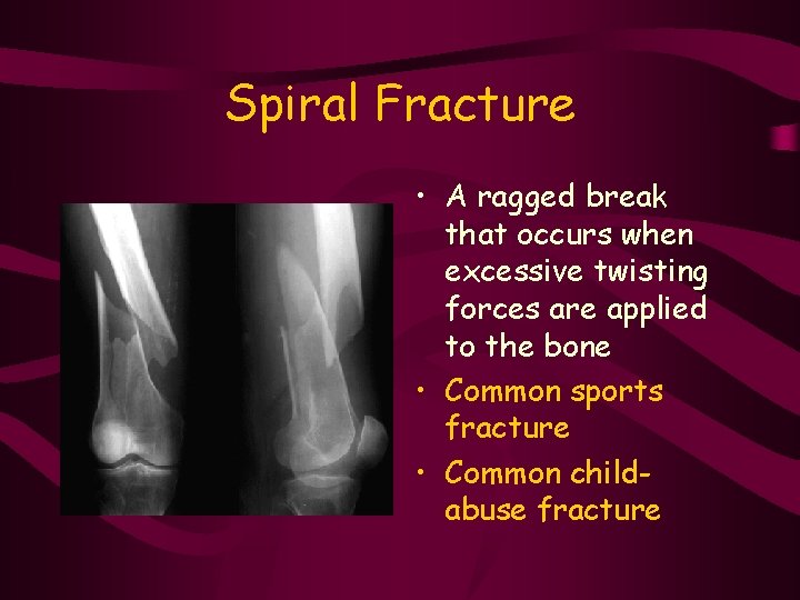 Spiral Fracture • A ragged break that occurs when excessive twisting forces are applied