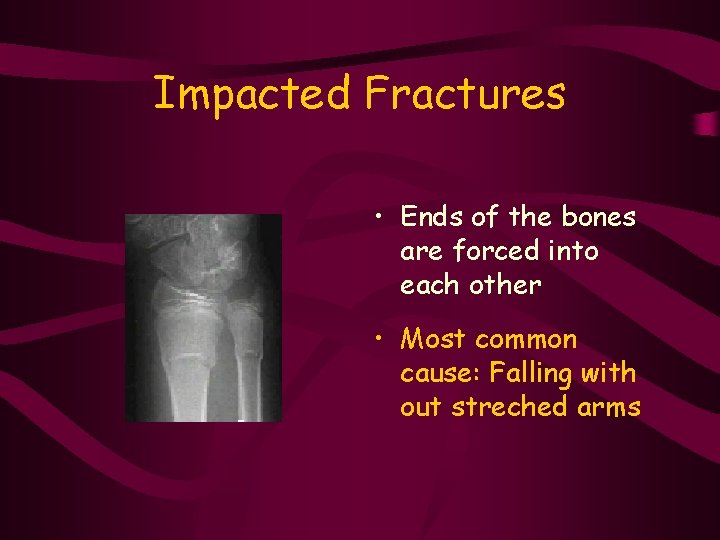 Impacted Fractures • Ends of the bones are forced into each other • Most