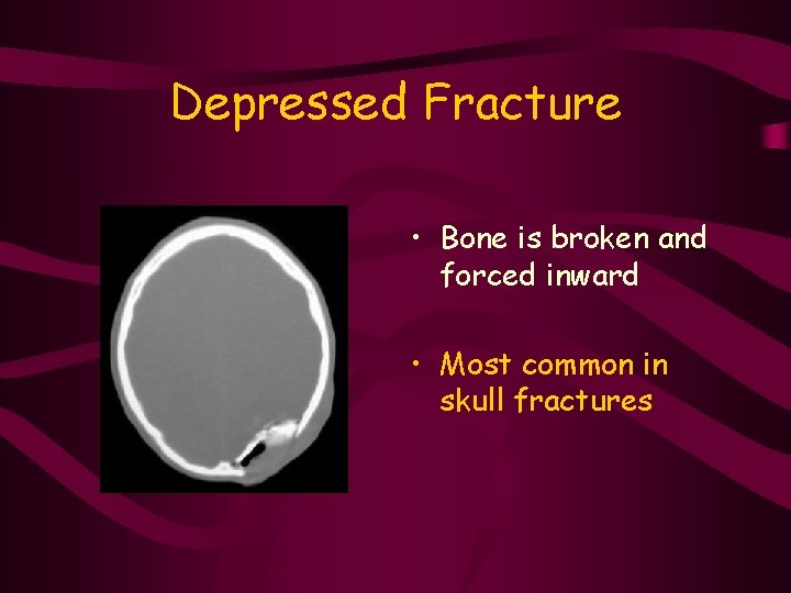 Depressed Fracture • Bone is broken and forced inward • Most common in skull