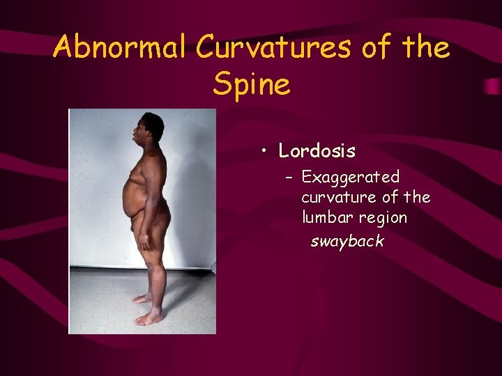 Abnormal Curvatures of the Spine • Lordosis – Exaggerated curvature of the lumbar region