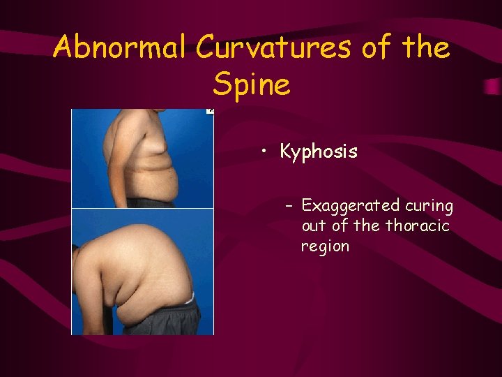 Abnormal Curvatures of the Spine • Kyphosis – Exaggerated curing out of the thoracic