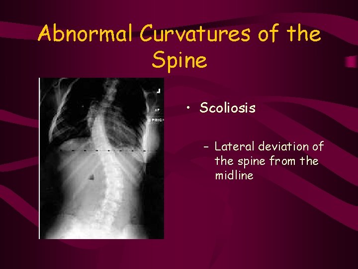 Abnormal Curvatures of the Spine • Scoliosis – Lateral deviation of the spine from