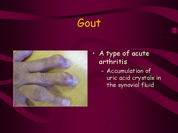 Gout • A type of acute arthritis – Accumulation of uric acid crystals in