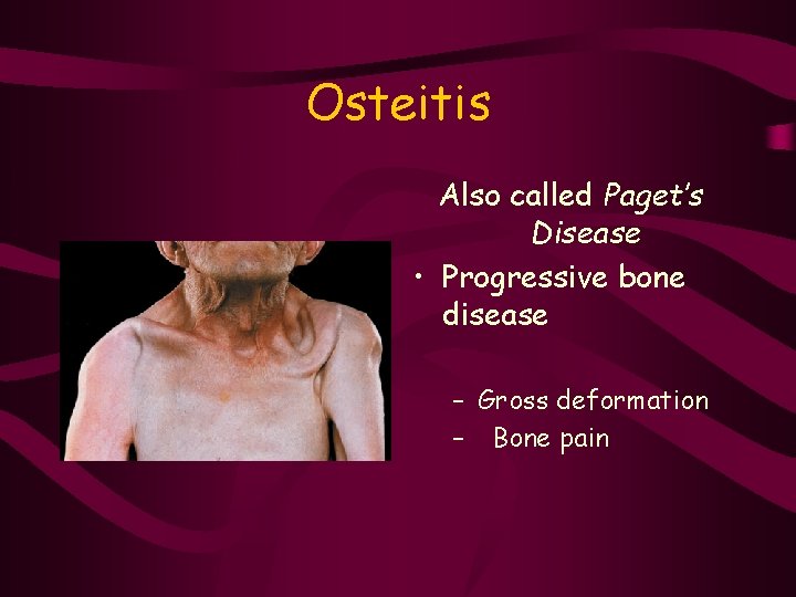 Osteitis Also called Paget’s Disease • Progressive bone disease – Gross deformation – Bone