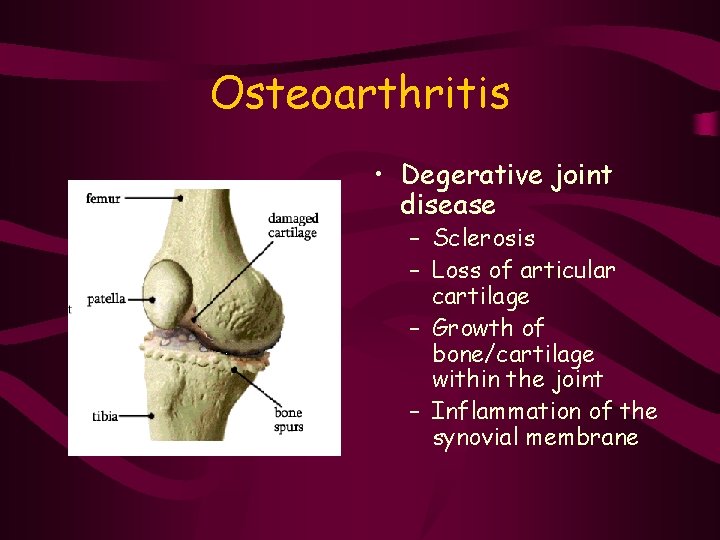 Osteoarthritis • Degerative joint disease – Sclerosis – Loss of articular cartilage – Growth