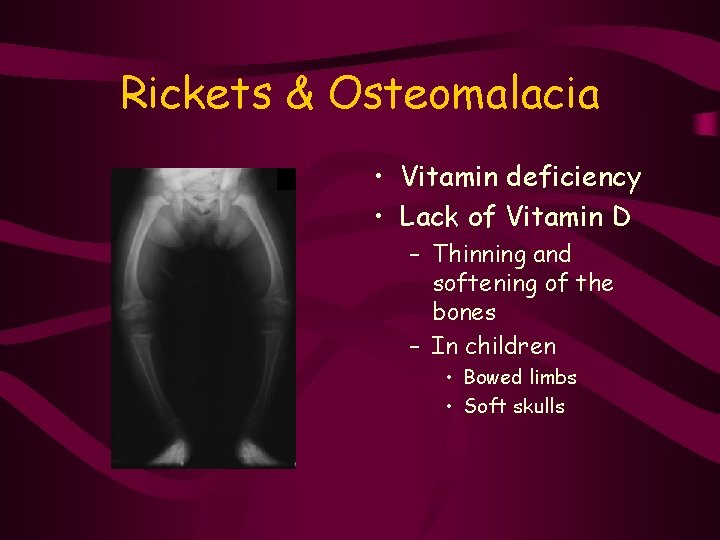 Rickets & Osteomalacia • Vitamin deficiency • Lack of Vitamin D – Thinning and