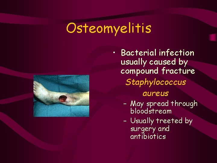 Osteomyelitis • Bacterial infection usually caused by compound fracture Staphylococcus aureus – May spread