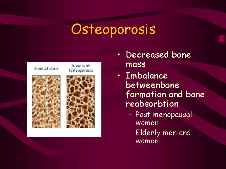 Osteoporosis • Decreased bone mass • Imbalance betweenbone formation and bone reabsorbtion – Post