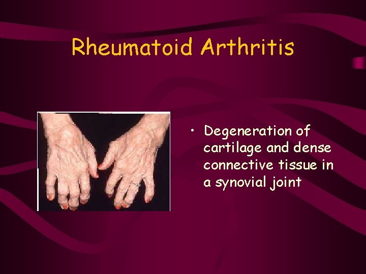 Rheumatoid Arthritis • Degeneration of cartilage and dense connective tissue in a synovial joint