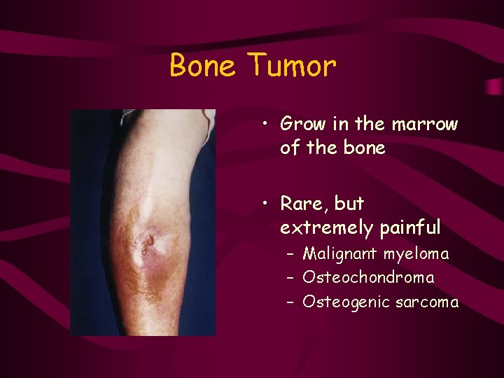 Bone Tumor • Grow in the marrow of the bone • Rare, but extremely