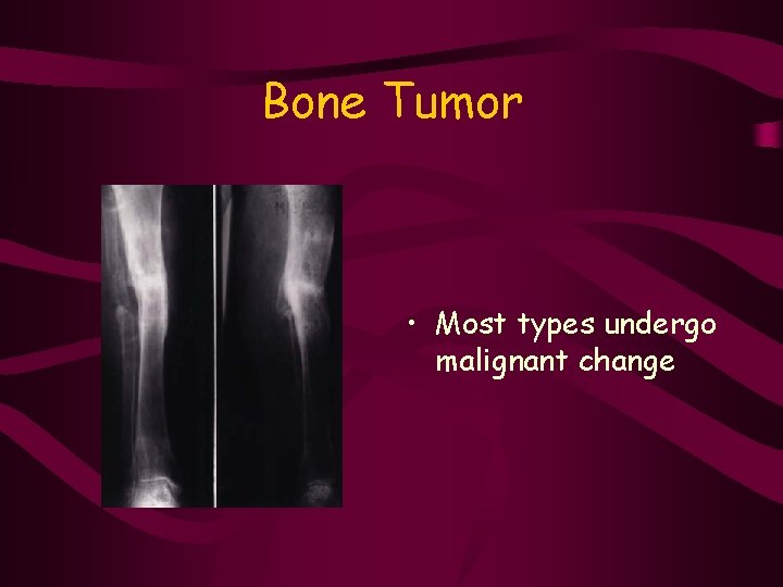 Bone Tumor • Most types undergo malignant change 