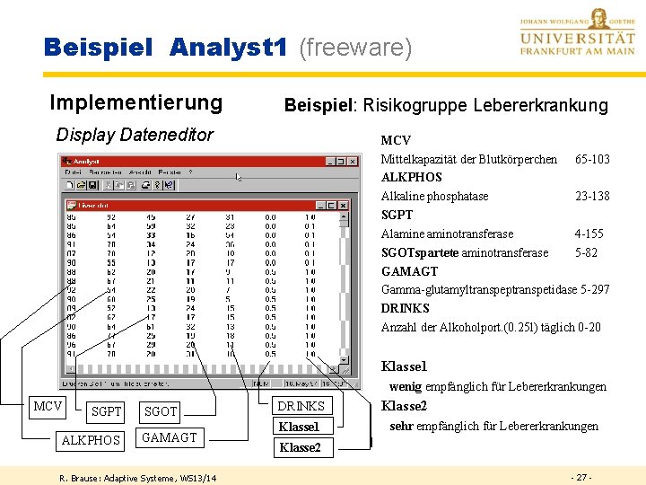 Beispiel Analyst 1 (freeware) Implementierung Beispiel: Risikogruppe Lebererkrankung Display Dateneditor MCV Mittelkapazität der Blutkörperchen