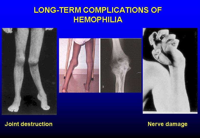 LONG-TERM COMPLICATIONS OF HEMOPHILIA Joint destruction Nerve damage 