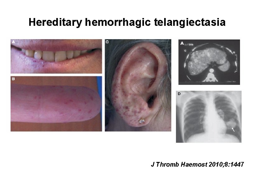 Hereditary hemorrhagic telangiectasia J Thromb Haemost 2010; 8: 1447 