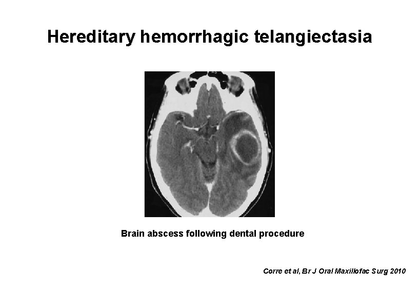 Hereditary hemorrhagic telangiectasia Brain abscess following dental procedure Corre et al, Br J Oral