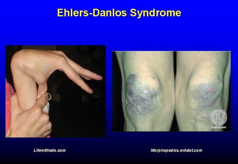 Ehlers-Danlos Syndrome Lifewitheds. com Morphopedics. wikdot. com 