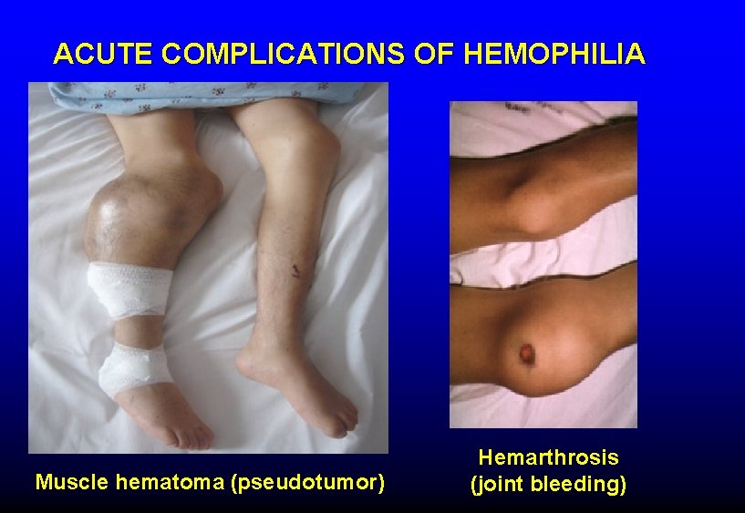 ACUTE COMPLICATIONS OF HEMOPHILIA Muscle hematoma (pseudotumor) Hemarthrosis (joint bleeding) 