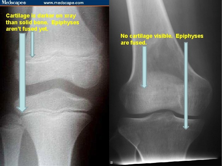 Cartilage is darker on xray than solid bone. Epiphyses aren’t fused yet. No cartilage