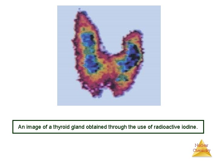 An image of a thyroid gland obtained through the use of radioactive iodine. Nuclear