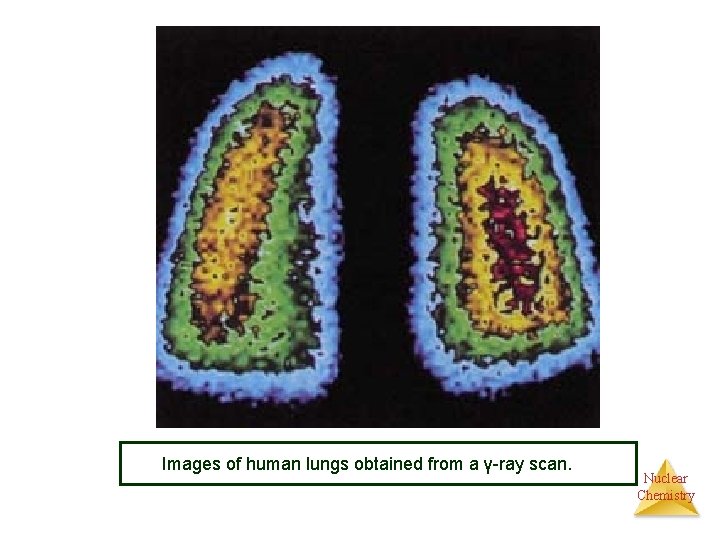 Images of human lungs obtained from a γ-ray scan. Nuclear Chemistry 