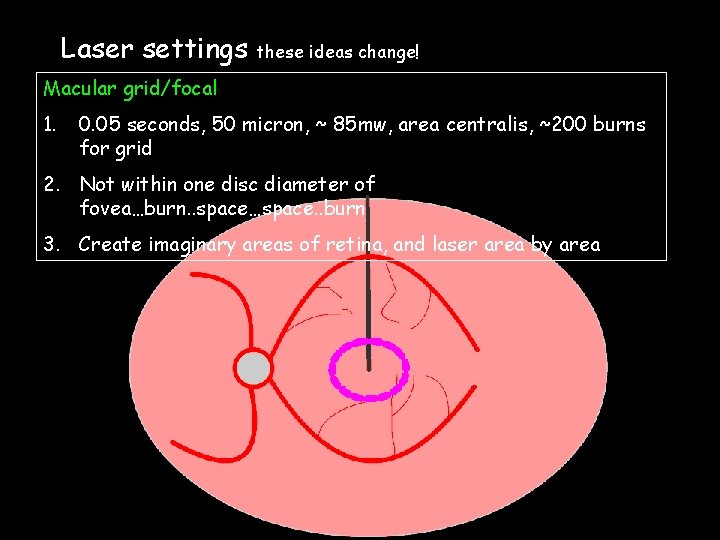 Laser settings these ideas change! Macular grid/focal 1. 0. 05 seconds, 50 micron, ~