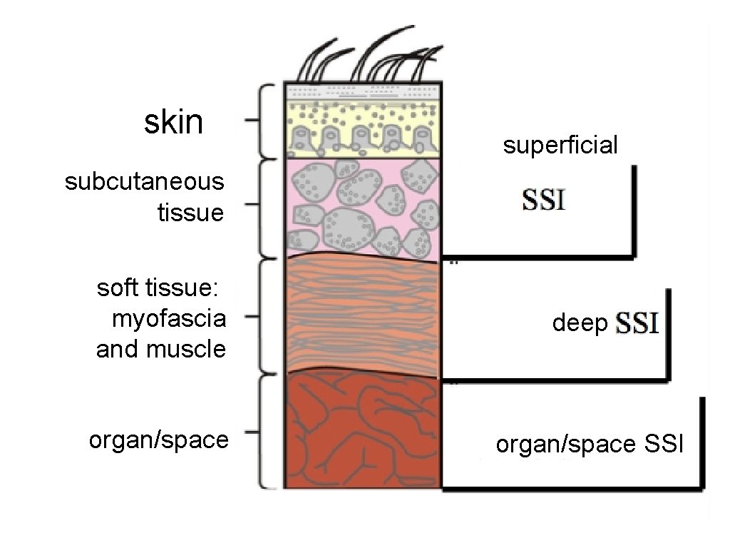 skin superficial subcutaneous tissue soft tissue: myofascia and muscle organ/space deep organ/space SSI 