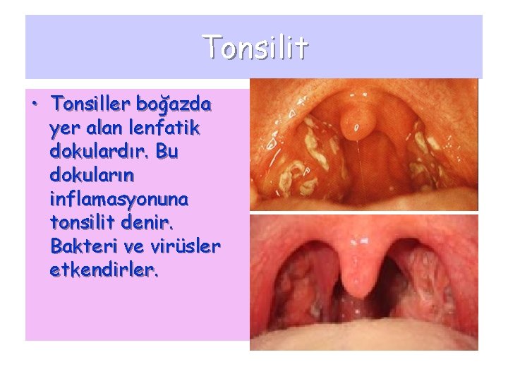 Tonsilit • Tonsiller boğazda yer alan lenfatik dokulardır. Bu dokuların inflamasyonuna tonsilit denir. Bakteri
