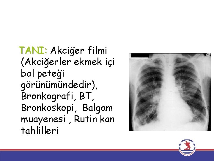 TANI: Akciğer filmi (Akciğerler ekmek içi bal peteği görünümündedir), Bronkografi, BT, Bronkoskopi, Balgam muayenesi