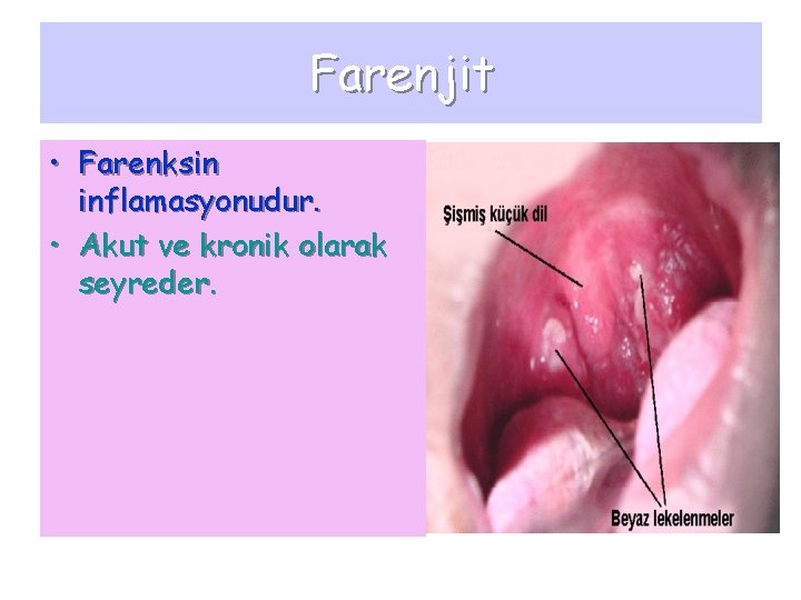 Farenjit • Farenksin inflamasyonudur. • Akut ve kronik olarak seyreder. 