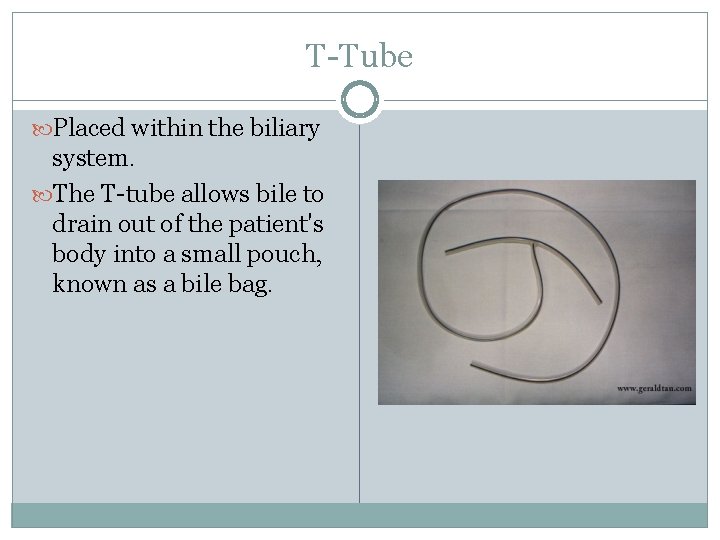 T-Tube Placed within the biliary system. The T-tube allows bile to drain out of