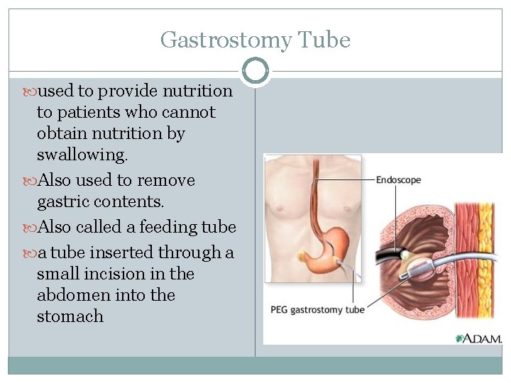 Gastrostomy Tube used to provide nutrition to patients who cannot obtain nutrition by swallowing.