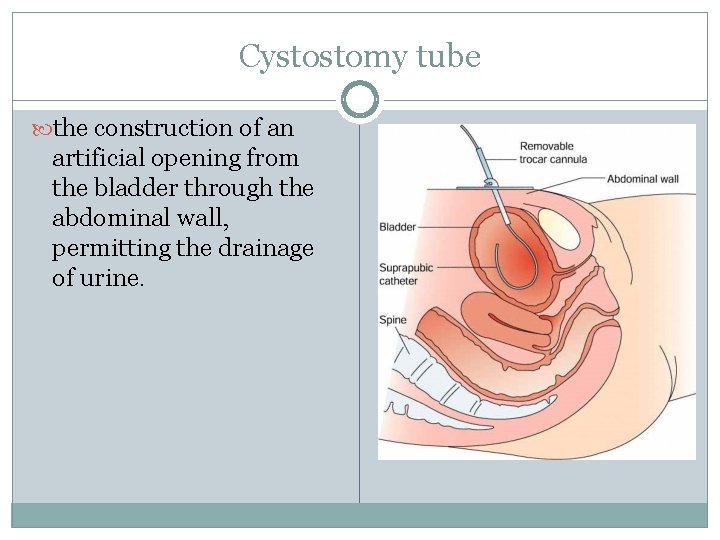 Cystostomy tube the construction of an artificial opening from the bladder through the abdominal