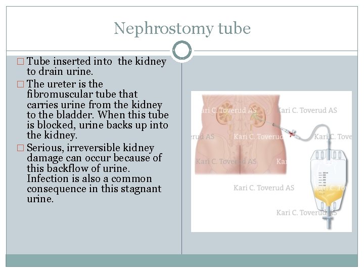 Nephrostomy tube � Tube inserted into the kidney to drain urine. � The ureter