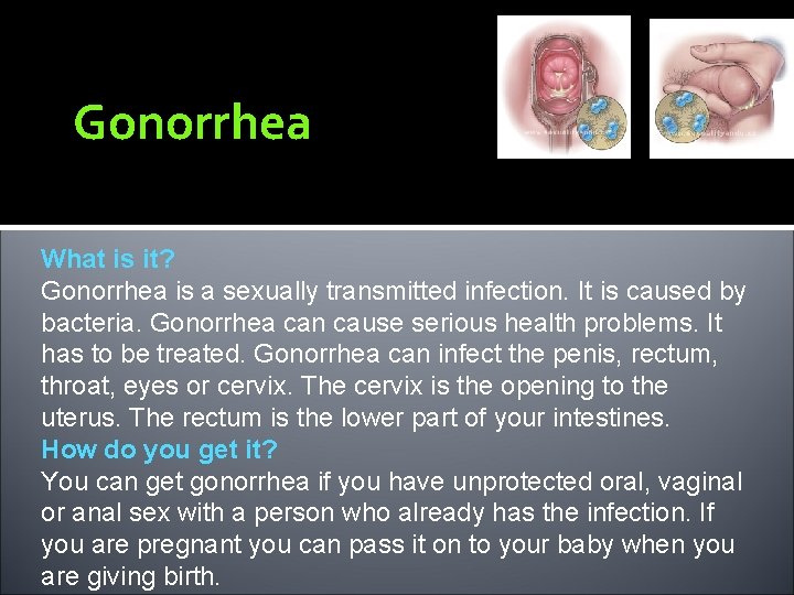 Gonorrhea What is it? Gonorrhea is a sexually transmitted infection. It is caused by