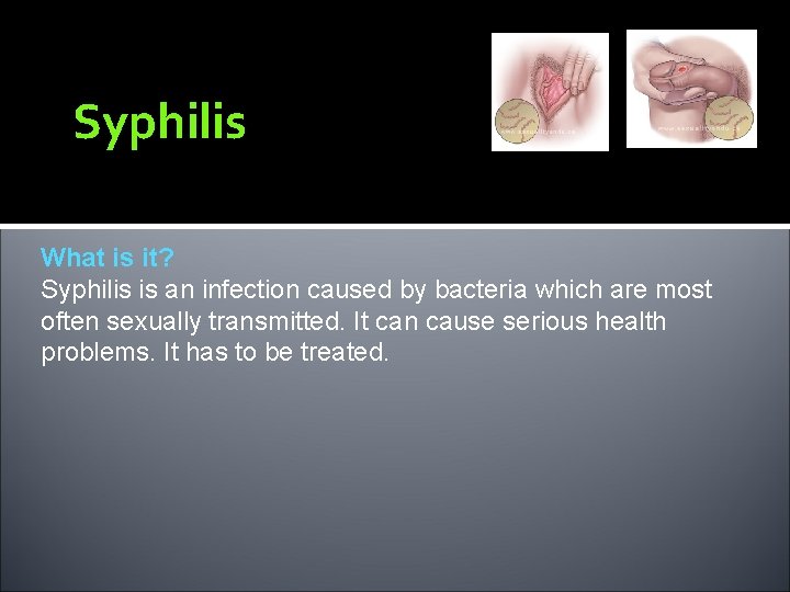 Syphilis What is it? Syphilis is an infection caused by bacteria which are most