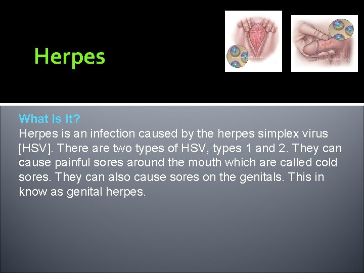 Herpes What is it? Herpes is an infection caused by the herpes simplex virus