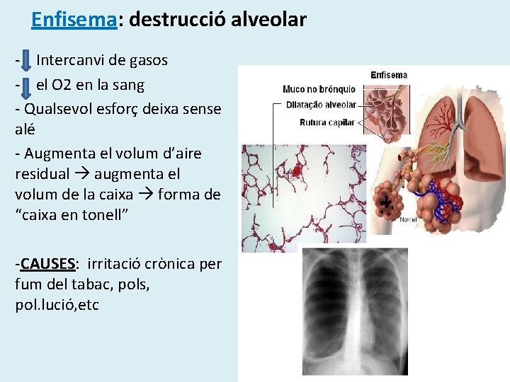 Enfisema: destrucció alveolar - Intercanvi de gasos - el O 2 en la sang