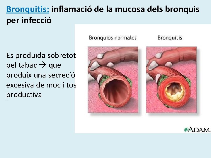 Bronquitis: inflamació de la mucosa dels bronquis per infecció Es produida sobretot pel tabac Bronquitis: inflamació de la mucosa dels bronquis per infecció Es produida sobretot pel tabac