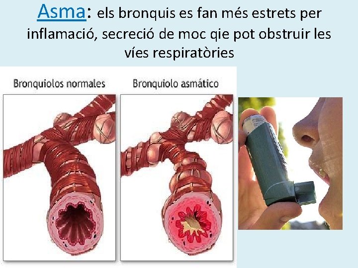 Asma: els bronquis es fan més estrets per inflamació, secreció de moc qie pot