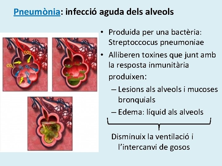 Pneumònia: infecció aguda dels alveols • Produida per una bactèria: Streptoccocus pneumoniae • Alliberen