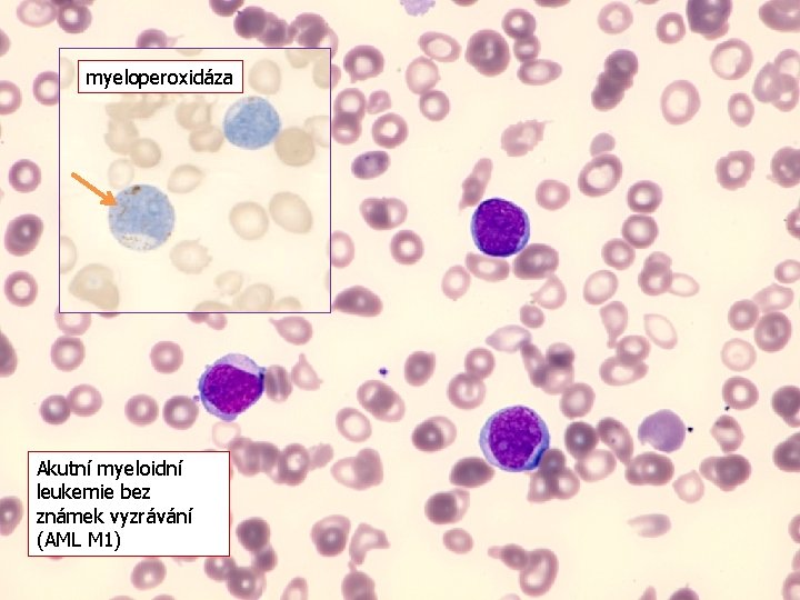 myeloperoxidáza Akutní myeloidní leukemie bez známek vyzrávání (AML M 1) 