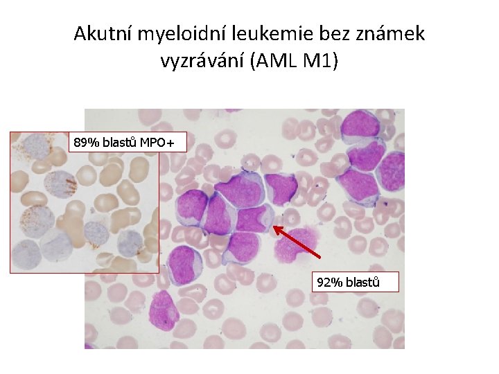 Akutní myeloidní leukemie bez známek vyzrávání (AML M 1) 89% blastů MPO+ 92% blastů